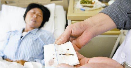 通過手術(shù)取出的針。　　商報(bào)記者 