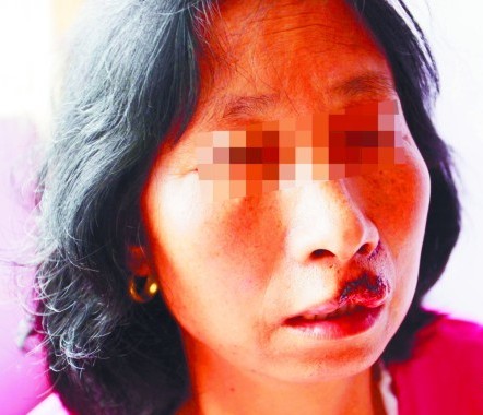 青島啃臉瘋狗闖小區連咬4人 女子嘴唇被咬掉一塊肉