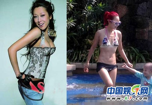 女星豐胸術