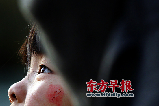 昨日，復(fù)旦大學(xué)附屬兒科醫(yī)院，7歲女童若若（化名）左邊臉頰還留有被劃破的傷痕。 早報(bào)記者 王辰 圖
