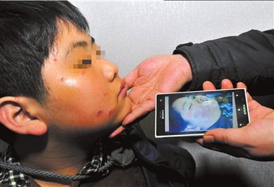 醫生手術操作失誤致使患兒臉部灼傷(圖)