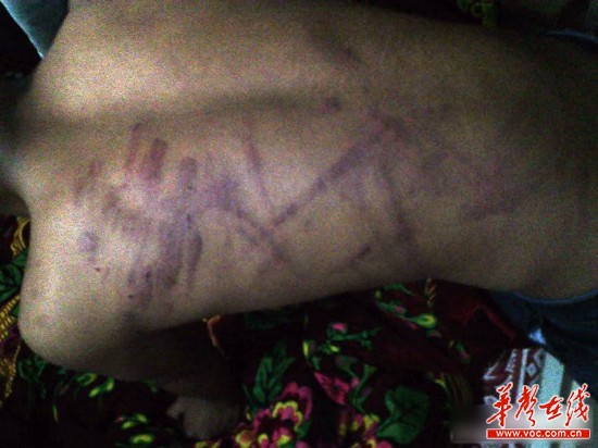 網曝云南省富源縣一名老師持續4小時體罰學生，期間打斷5根電線。（圖為被體罰學生）網絡截圖